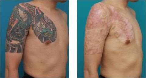 Surgical-Excision-of-a-Tattoo