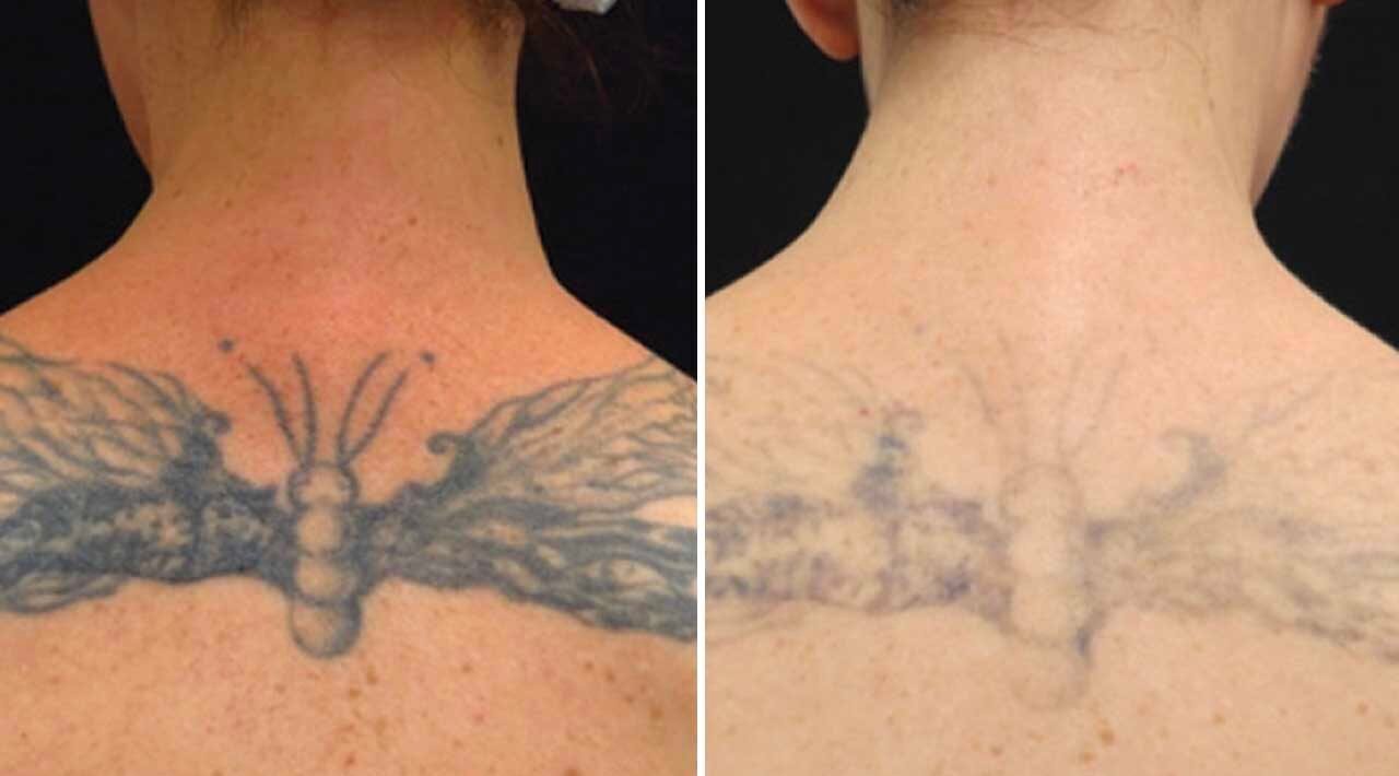 ba-tattoo-removal4